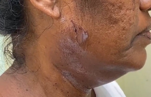 মর্মান্তিক! কোট্টায়ামে এসআইআর ফর্ম বিলি করতে গিয়ে কুকুরের কামড়ে জখম এক বিএলও মর্মান্তিক! কোট্টায়ামে এসআইআর ফর্ম বিলি করতে গিয়ে কুকুরের কামড়ে জখম এক বিএলও