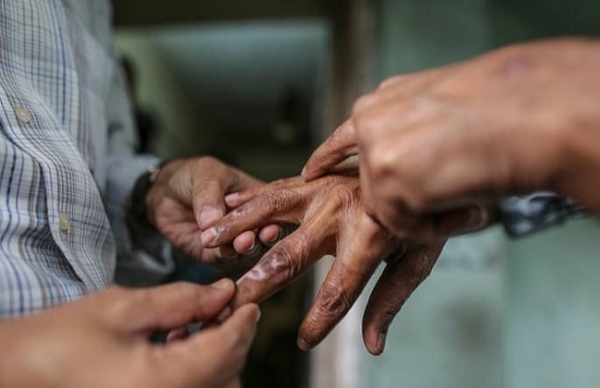 উচ্ছেদ ঘোষণার ১৬ বছর পর নেপালে ফের উদ্বেগ বাড়াচ্ছে কুষ্ঠরোগ