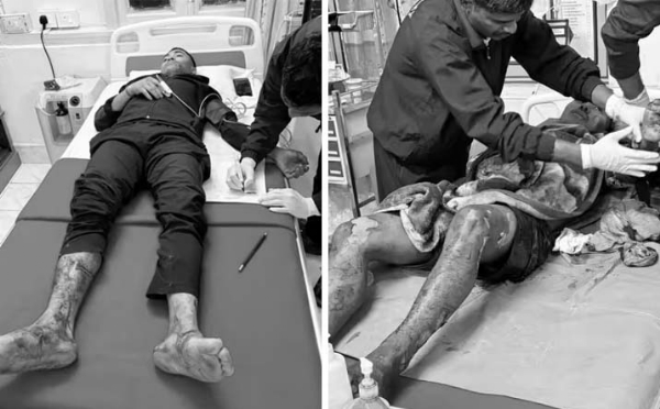 রকেট লঞ্চার হামলায় আহত আসাম পুলিশ কমান্ডোর দুই জওয়ান